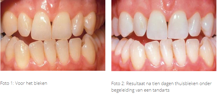 Ingang bagage pakket Wittere tanden: zelf tanden bleken of naar de tandarts? - Tandarts Bennink